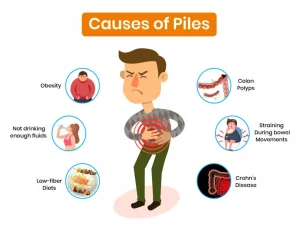 Piles Symptoms, Causes and Treatment Procedure